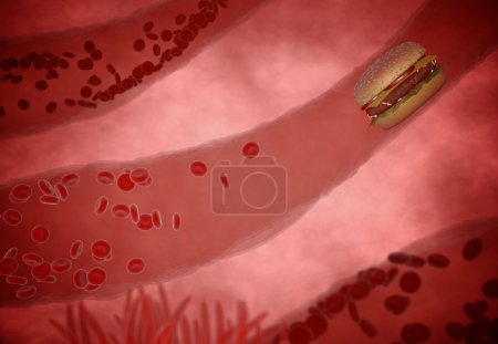 cholesterol blocked artery, medical concept with a human blood
